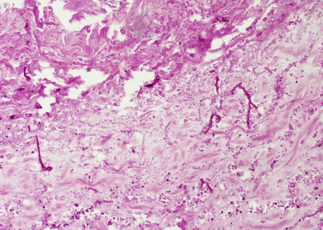 Bild 5: Nachweis der Schimmelpilzhyphen mittels Spezialf�rbung, PAS-Reaktion, 100fache Vergr��erung