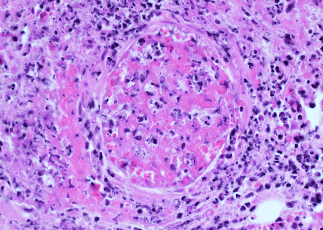 Bild 6: Fibrinoide Gef��nekrose, HE-F�rbung, 400fache Vergr��erung