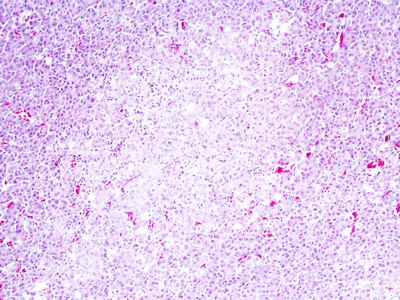 Bild 5: Nekrose der Azinuszellen der Bauchspeicheldrüse (HE, 200fache Vergrößerung)